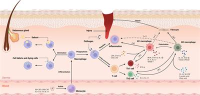 Macrophages in acne vulgaris: mediating phagocytosis, inflammation, scar formation, and therapeutic implications